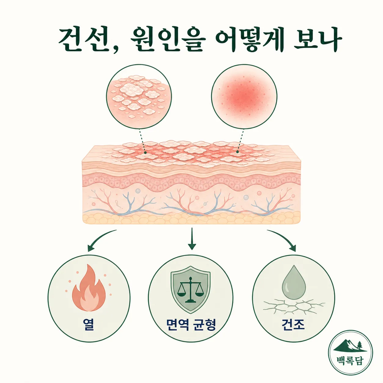 건선의 겉 증상과 몸속 조건(열·면역 균형·건조)을 연결한 한의학 관점 개념도