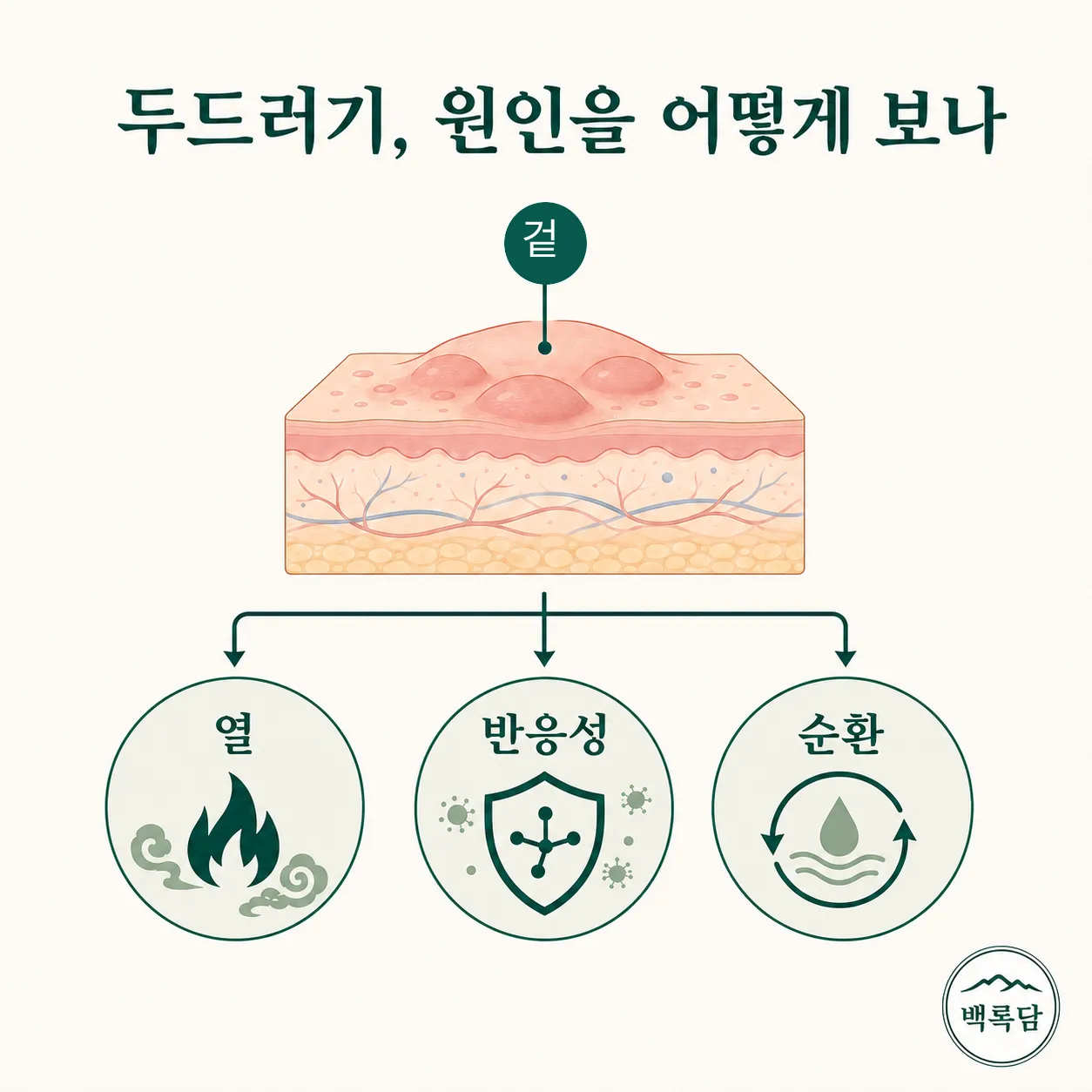 두드러기의 겉 증상과 몸속 조건(피부 방어력·열·반응성)을 연결한 한의학 관점 개념도