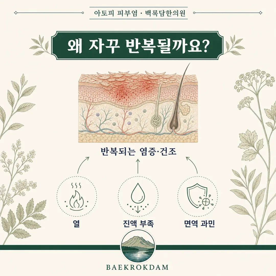 아토피의 겉 증상과 몸속 조건(열·진액 부족·면역 과민)을 연결한 한의학 관점 개념도